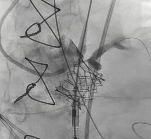 No time to waste! What do you see on this image submitted by a team from 🇬🇷 and selected for #EuroPCR? Test your knowledge here 🤔 pcronline.com/Cases-resource… #cardiotwitter #cardioed