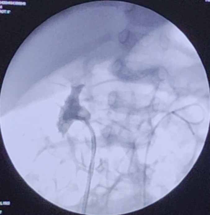 youtu.be/8IRjqzIwwC8 Infant RIRS is challenging. Urethral and ureteral damage can happen . After certain experience in RIRS, we are doing more often RIRS in infants and small children. Few days back bilateral RIRS in small kid 1 and half year done. Discharged. No prior…