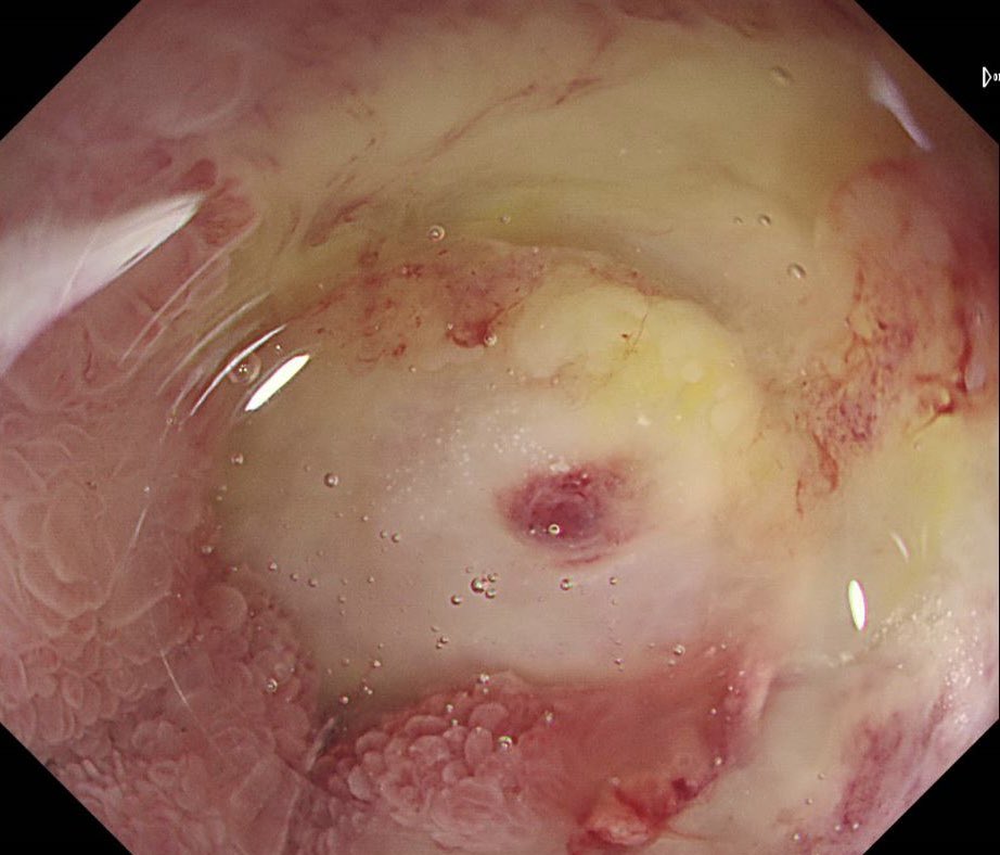 Seen in the duodenum of a patient with GI bleeding. What would you do? #WithConsent