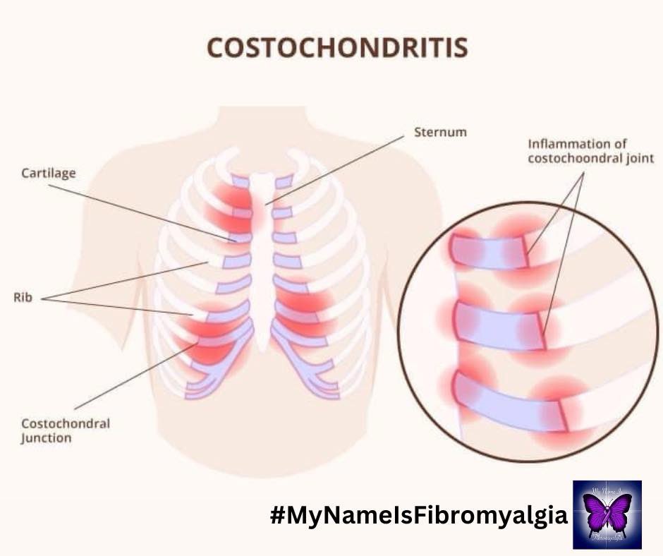 Chest pain! It can be so scary. Costochondritis is a condition which cause inflammation of the junction where the upper ribs join with the cartilage that holds them to the breastbone or sternum. The condition causes localized chest wall pain and tenderness that can be
