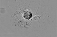SevdeAltuntas's tweet image. We&apos;re developing patient-derived pancreatic #tumoroids. Our goal is to measure the effectiveness of cancer drugs under #humano conditions. It&apos;s a team effort involving 3 @sbuedutr hospitals and #AltuntasLab. We couldn&apos;t be prouder of turning this into reality!🩷 @SBUDETUAM #devam