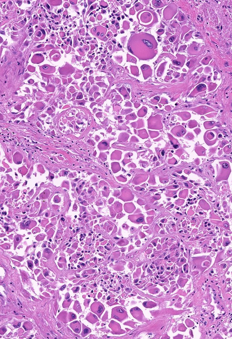 40 F axilla mass. What term would you use to describe the #cytology? Your diagnosis? 
WSI digital slide: kikoxp.com/posts/8152. 
Answer & video: youtube.com/watch?v=vKPX9e… 
#BSTpath #pathology #pathologists #pathTwitter #dermpath #dermatology #dermatologia #dermtwitter