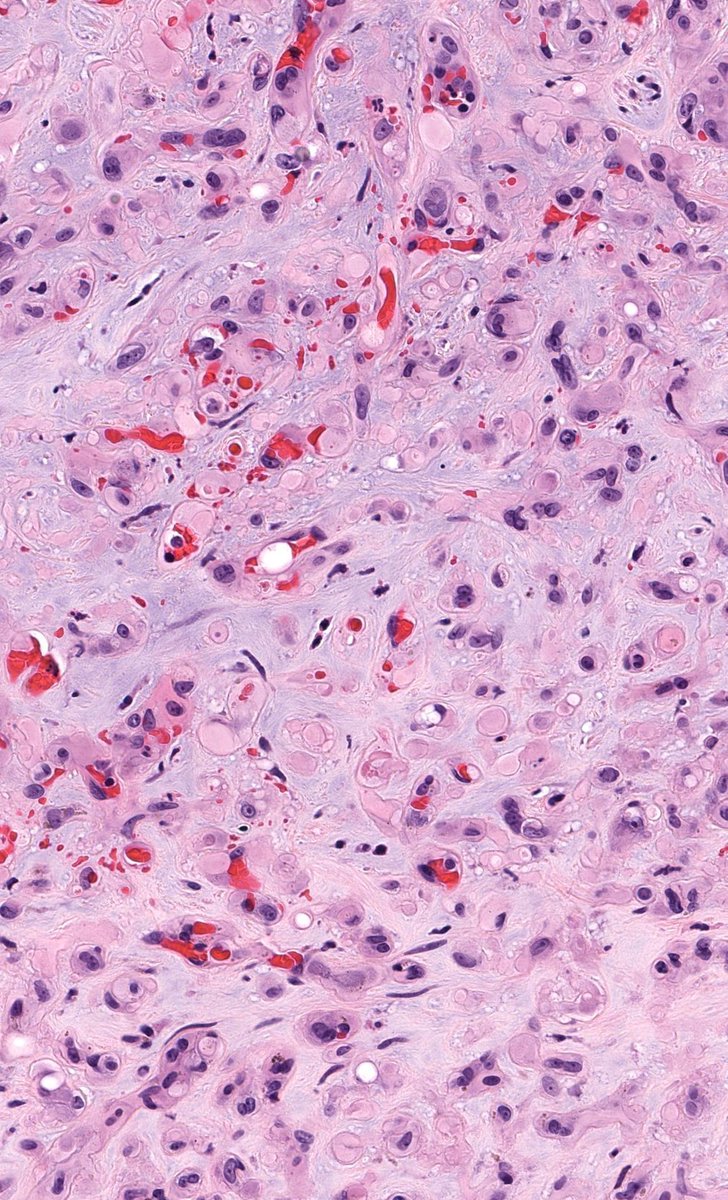 30 F. Mass in lumen of femoral vein. Diagnosis? WSI digital slides: kikoxp.com/posts/21727 Immunostains: kikoxp.com/posts/21729 Answer & Video: kikoxp.com/posts/21501 #pathology #pathologists #pathTwitter #dermpath #dermatology #dermatologia #dermtwitter #BSTpath