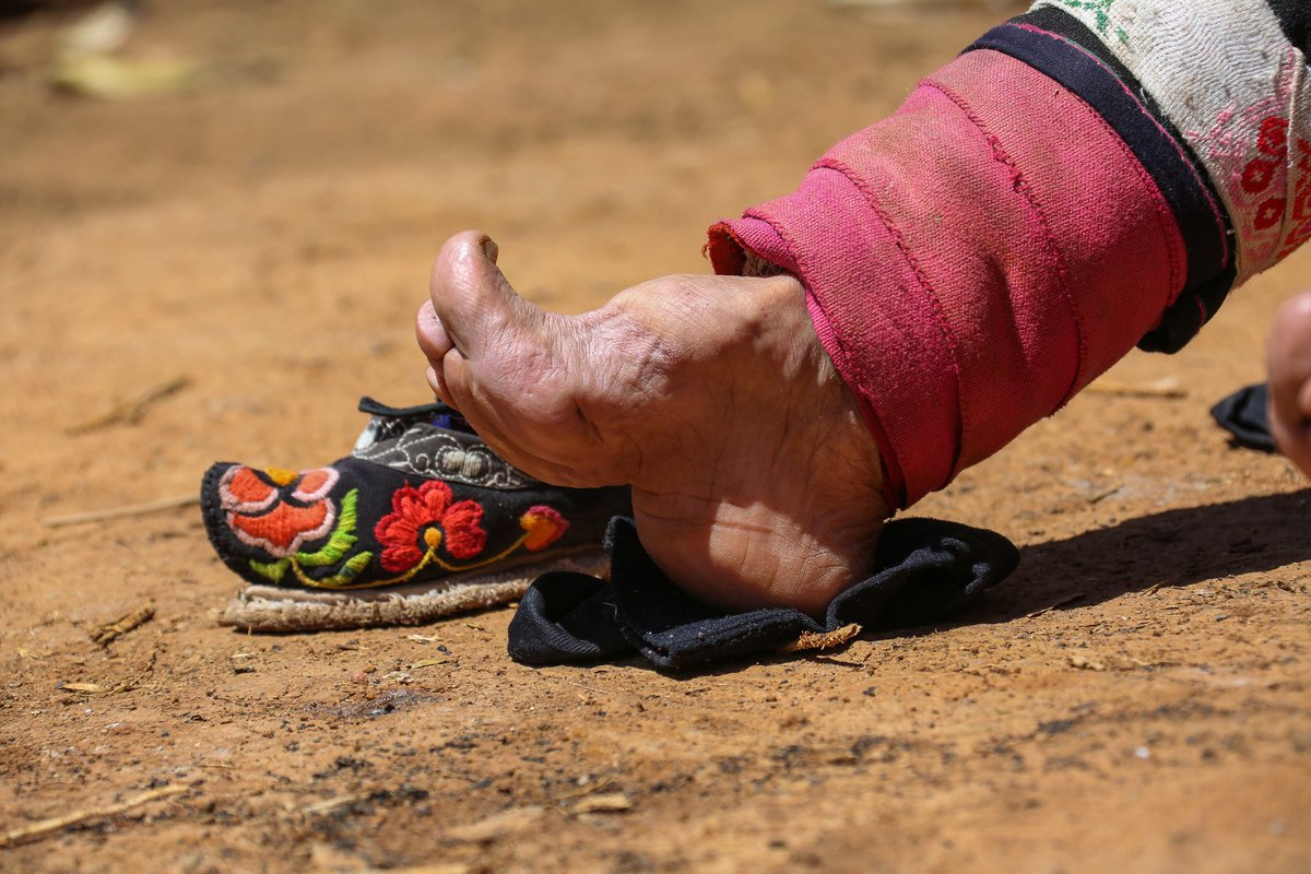 The practice of foot-binding.
Horrific thing to do to young children eh?
Imagine torturing your body to change its appearance so radically and for a fashion.

So why are chest binders ok according to the Scottish Government?