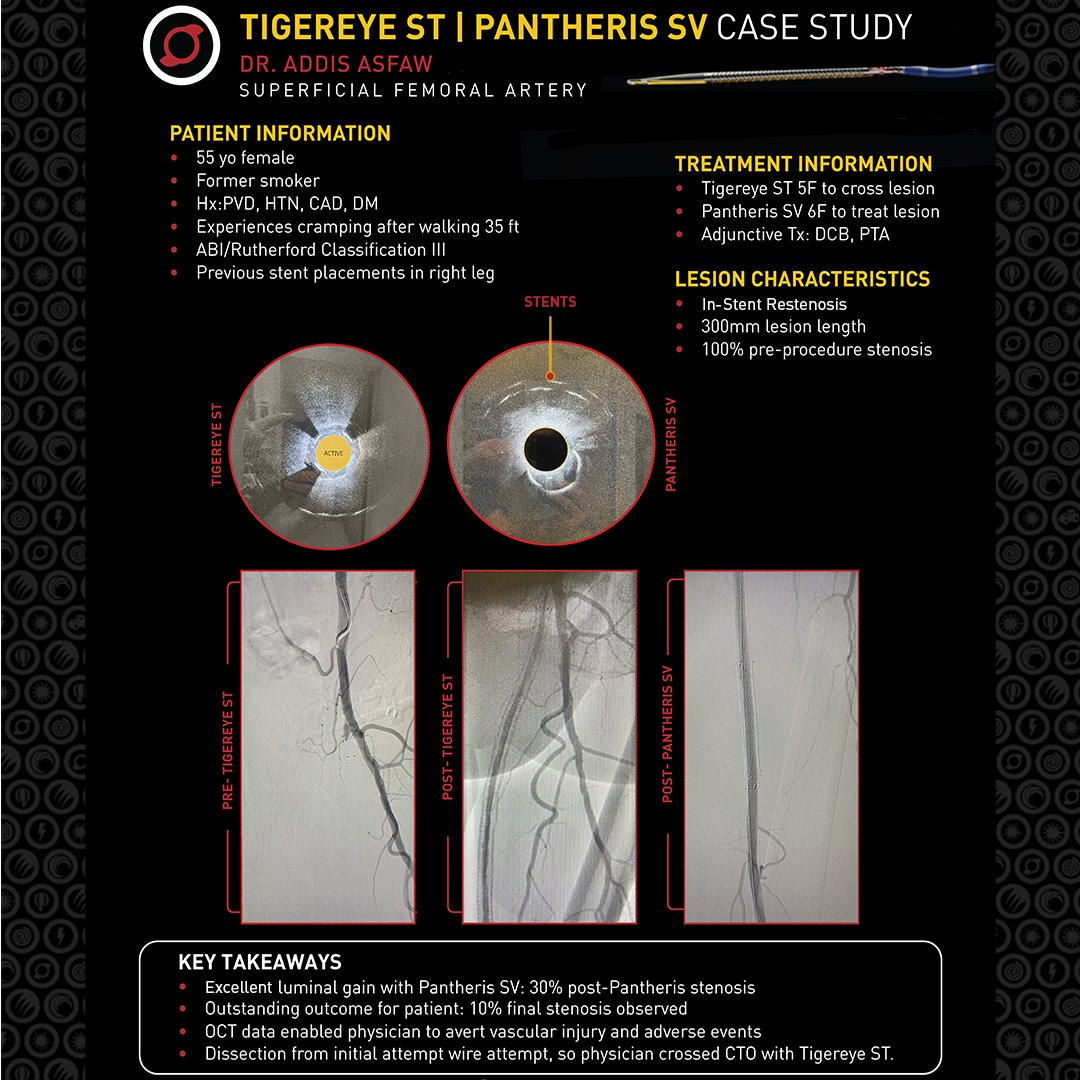 🥇First-time use of Avinger’s Tigereye ST & Pantheris SV leads to remarkable success in a difficult ISR CTO case! Dr. Asfaw achieved excellent results without additional stenting. A true testament to innovation in patient care! #FirstUse #MedicalDevices #HealthTech #PatientCare