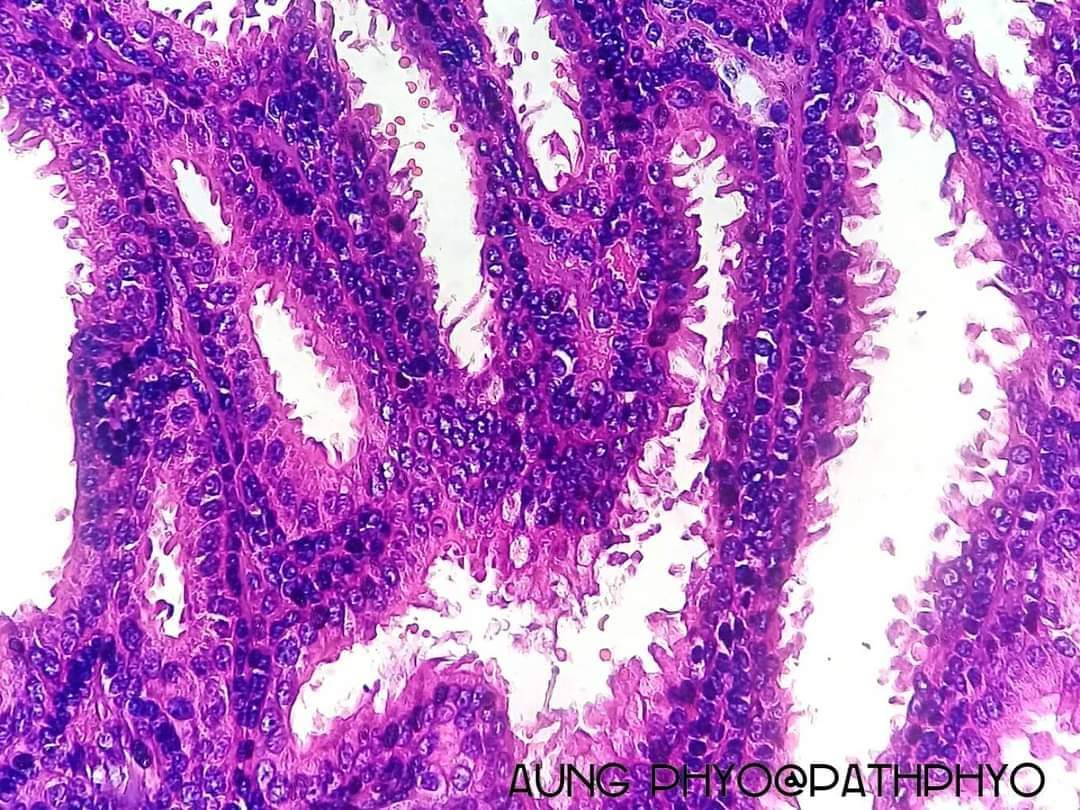 A nice example of tubular apocrine adenoma presenting as a nodule at angle of mouth. It features nice apocrine snouts (apical decapitation secretion). #pathology #dermpath