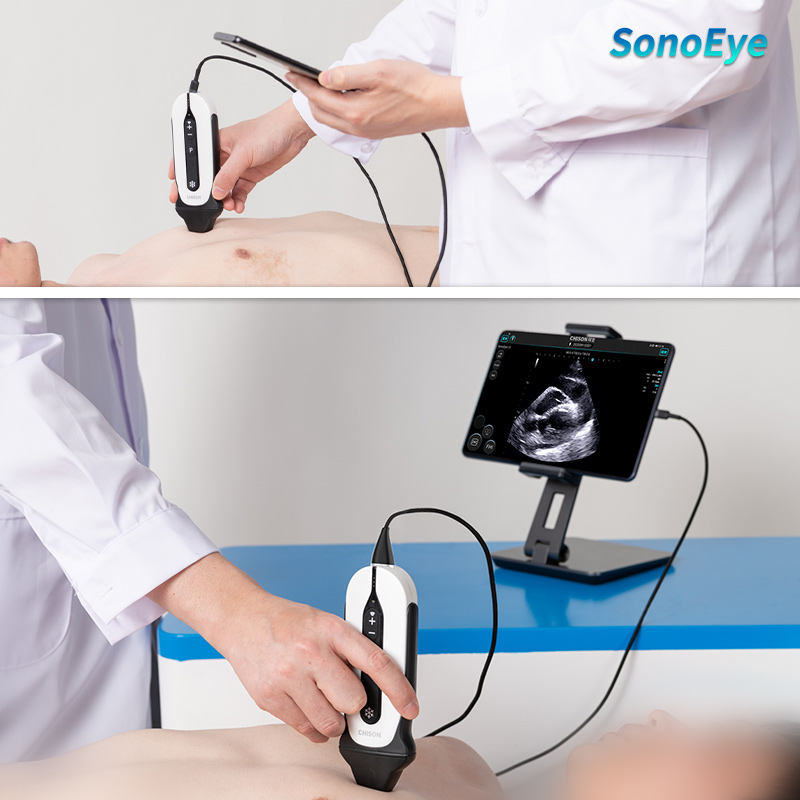 #SonoEye P3, a portable, lightweight handheld cardiac ultrasound device. For various clinical settings like #cardiology clinics, #emergencymedicine, lung ultrasound, etc. Its fast response ensures top performance in diverse scenarios, adapting quickly to meet your needs. 🩺💓