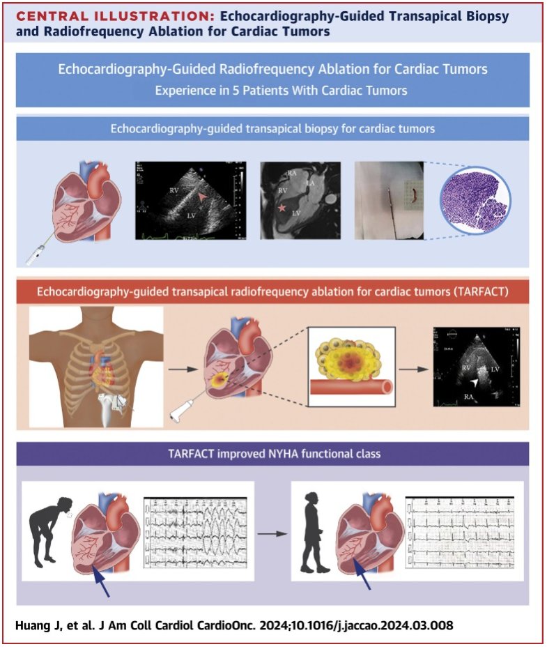 Can radiofrequency be used to treat cardiac tumors? Thanks to @JACCJournals for the opportunity with John Plastaras to discuss this concept and important lessons from #RadiateVT and decades of #EPeeps using RF in the heart. @PennCancer #Radonc jacc.org/doi/10.1016/j.…
