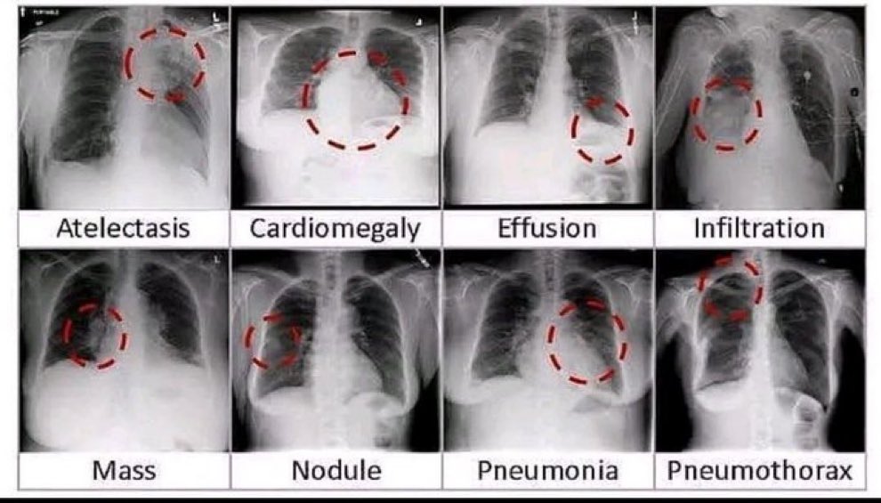 Chest X-Ray Findings 🩻