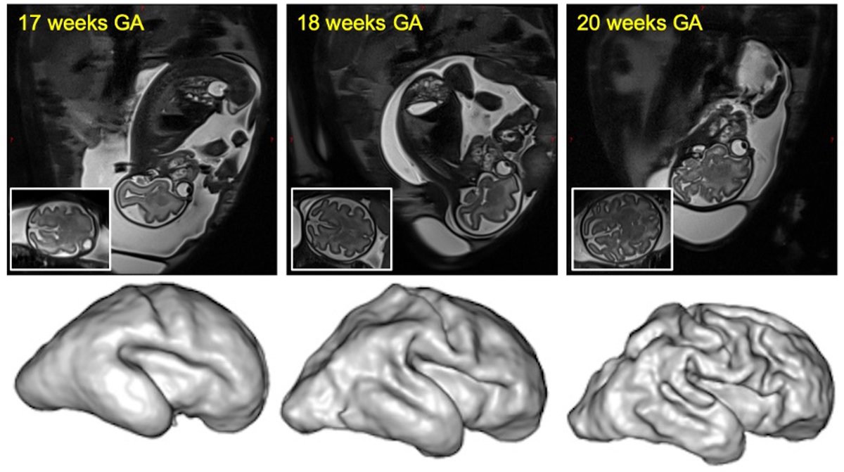 ⚠️ Job Alert 📷 we are looking for a motivated student to embark with us for a PhD on the great topic of fetal development using MRI. url.univ-amu.fr/devfet