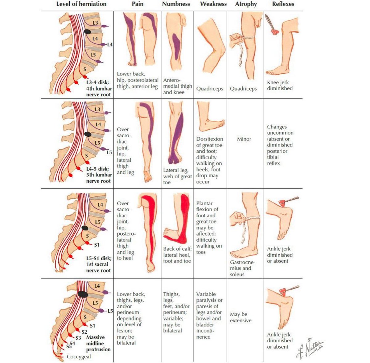 Nerve root syndromes associated with lumbar disc herniation 💡