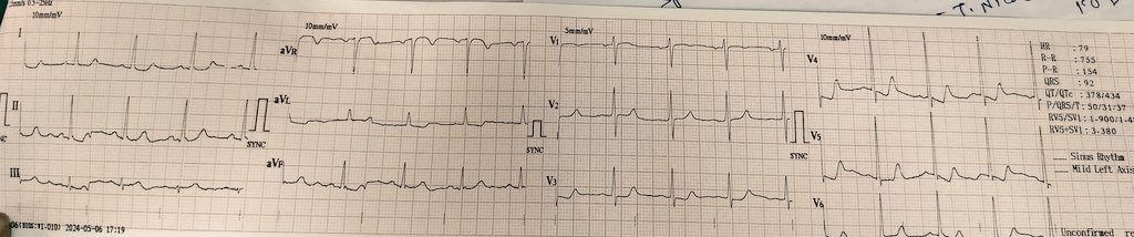 K/c/o DM, CKD with chest discomfort since 8 days. Serum Triglycerides - 698 mg/dL, HDL - 38 mg/dL.
What do you see?