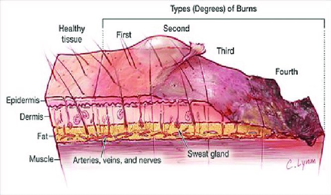 Fourth degree burns - go through both layers of skin and deeper tissues possibly involving muscle and bone. Patients will not feel any pain over the affected area since nerve endings are destroyed. Harap2 si pelaku akan dijatuhkan hukuman yang berat. Get well soon and semoga…