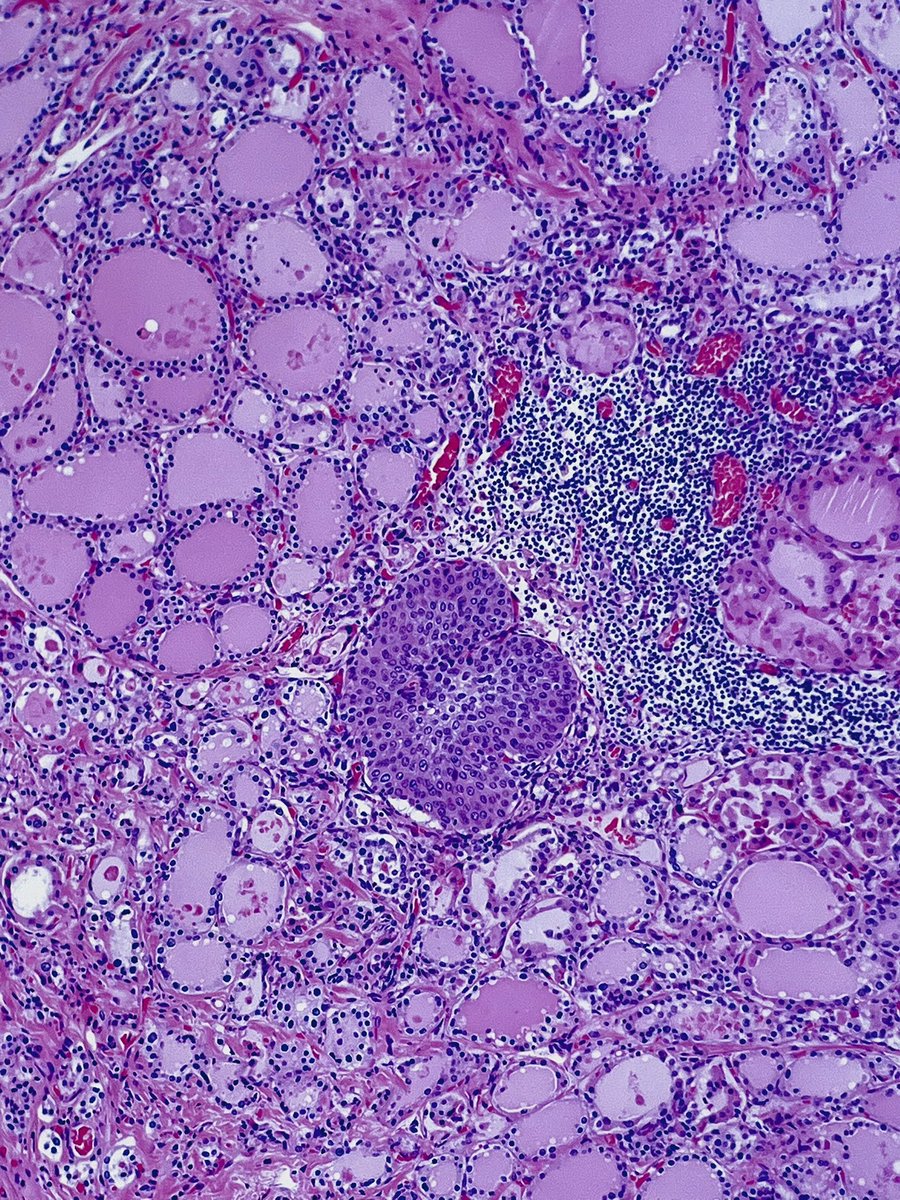 What is this incidental finding in the thyroid?
Hint: it’s benign 🔬
@UMichPath #headneckpath #ENTpath 
 #thyroid #pathfinds #microscopemonday