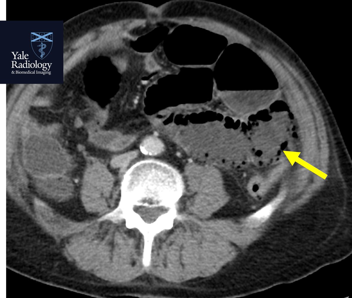 #MEDSTUDENTMONDAYS: portal venous gas + bowel pneumatosis in this patient with bowel ischemia! #yaleradedu #yaleradiology #MedStudentMondays #FOAMrad #FOAMed #radres @Mahan_Mathur @YaleRadiology #MedTwitter