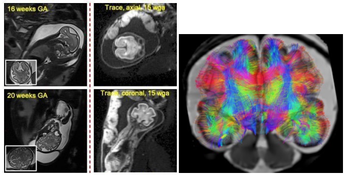 ⚠️ Another Job Alert !!! ⚠️ We are looking for a research engineer to help us with fetal diffusion MR image reconstruction and analysis. Spread the word and have a look: url.univ-amu.fr/dwifet