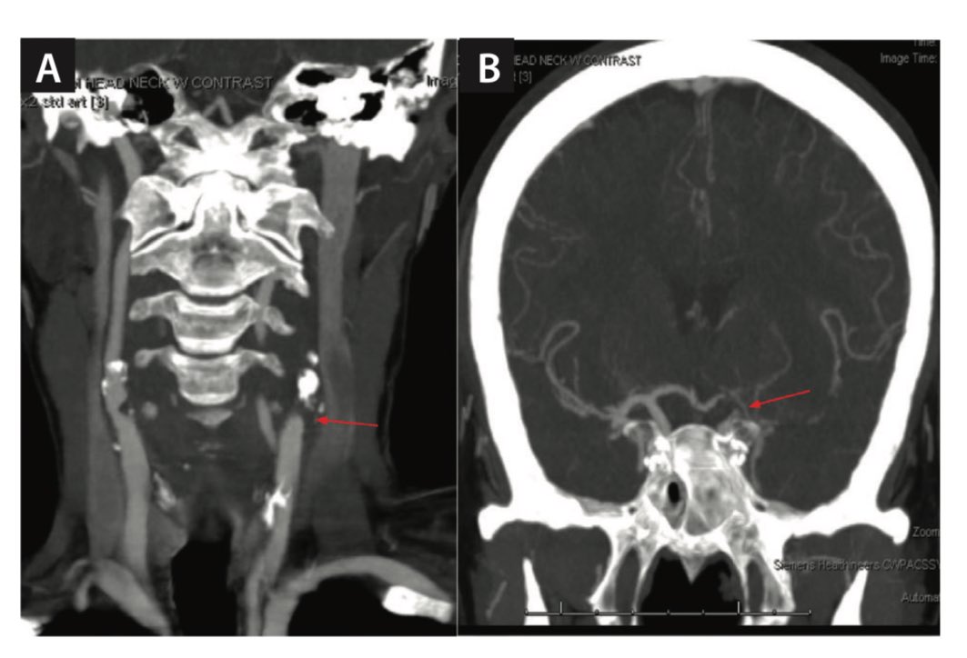 Acute Ischemic Stroke With Tandem Occlusion Requiring Cervical and Intracranial Revascularization on <a href="/EVToday/">Endovascular Today</a> evtoday.com/articles/2024-…