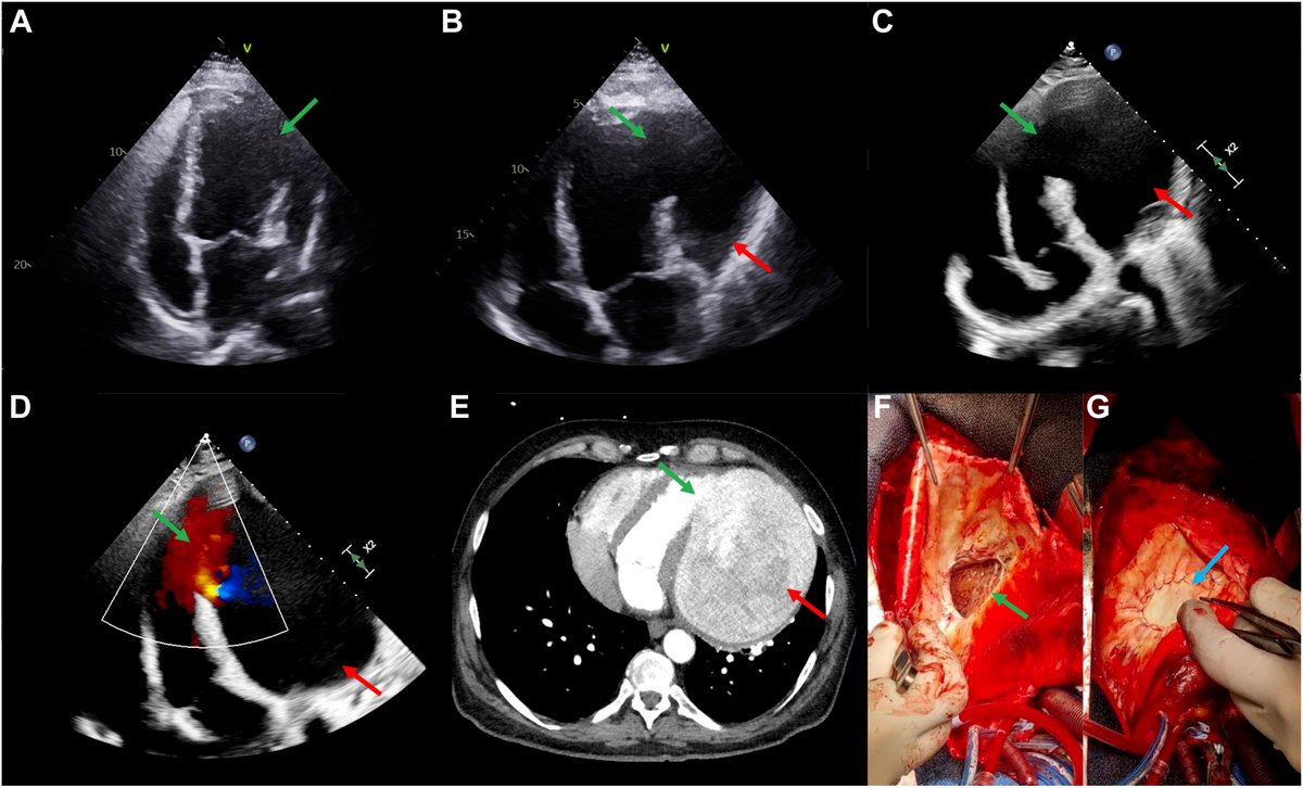 Imaging of a massive left ventricular pseudoaneurysm enlarging over 6 months! Full article 👉 cjcopen.ca/article/S2589-… 🌐 #CJCO #LeftVentricularPseudoaneurysm