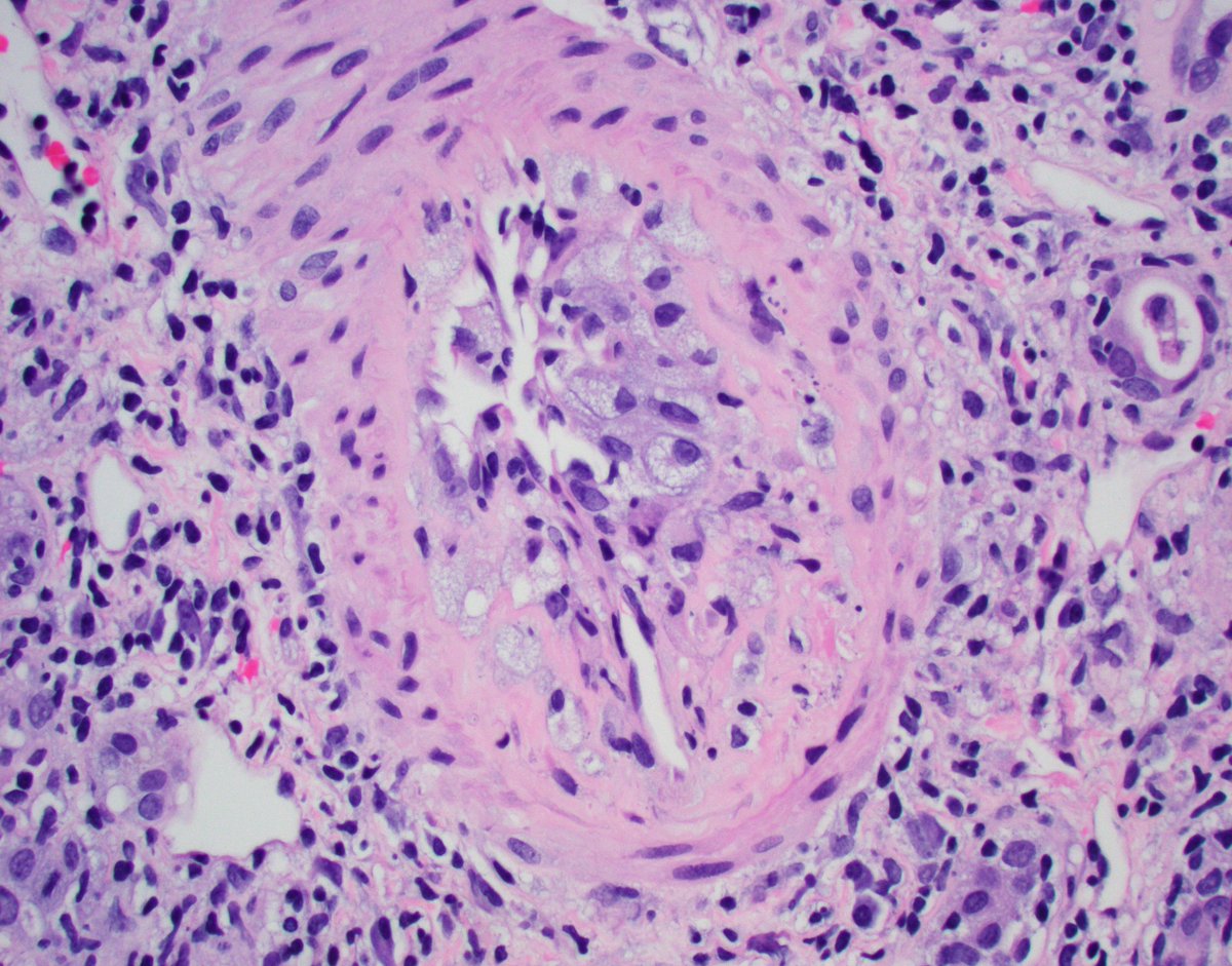 Ouch. Severe acute vascular rejection (v3 lesion) with transmural inflammation and fibrinoid necrosis with chronic transplant arteriopathy (foam cells; intimal sclerosis) in this kidney txp bx. +DSAs and diffuse tubulointerstitial type ACR. #renalpath #nephrology