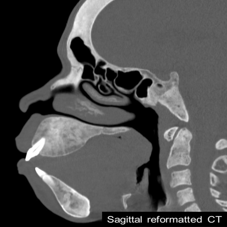 #AJNRcc >> May 6, 2024 >> What is the diagnosis for this 36-year-old man with end-stage renal disease on hemodialysis presents with a suspicious palatal lesion? Submit your answer at ow.ly/eNbf50RxTkj.