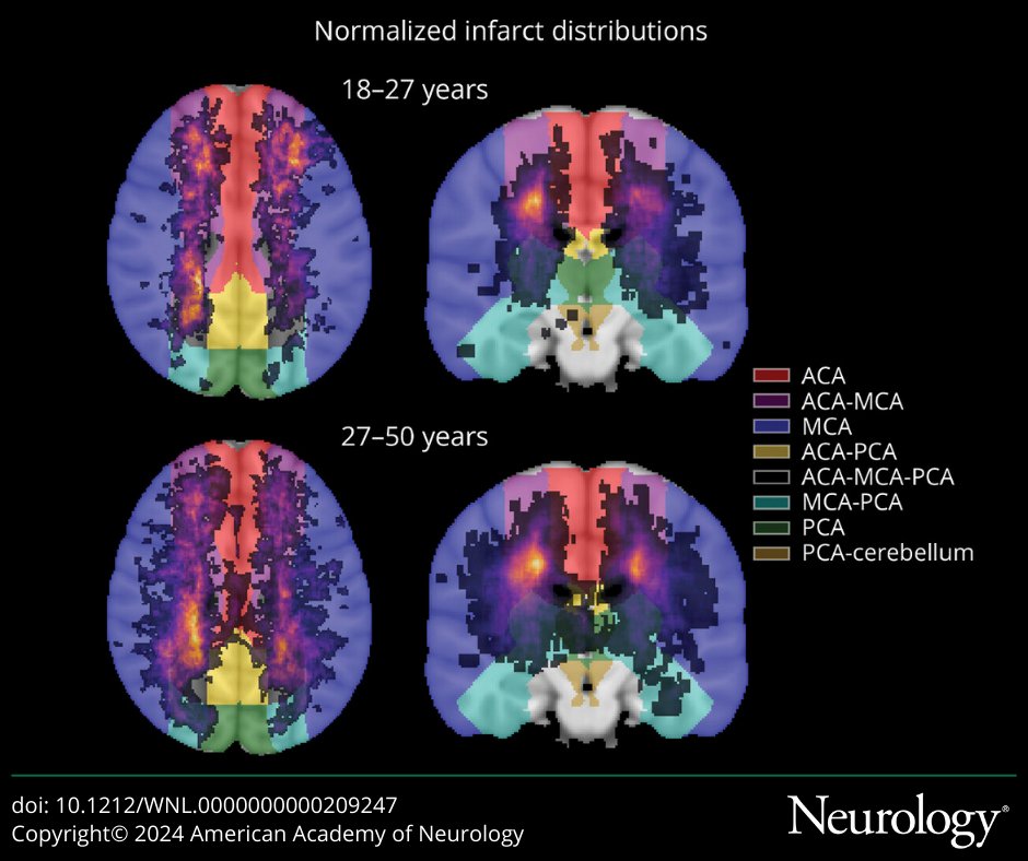 Distribution of Silent Cerebral Infarcts in Adults With Sickle Cell Disease: bit.ly/4domUuK #NeuroTwitter #Neurology