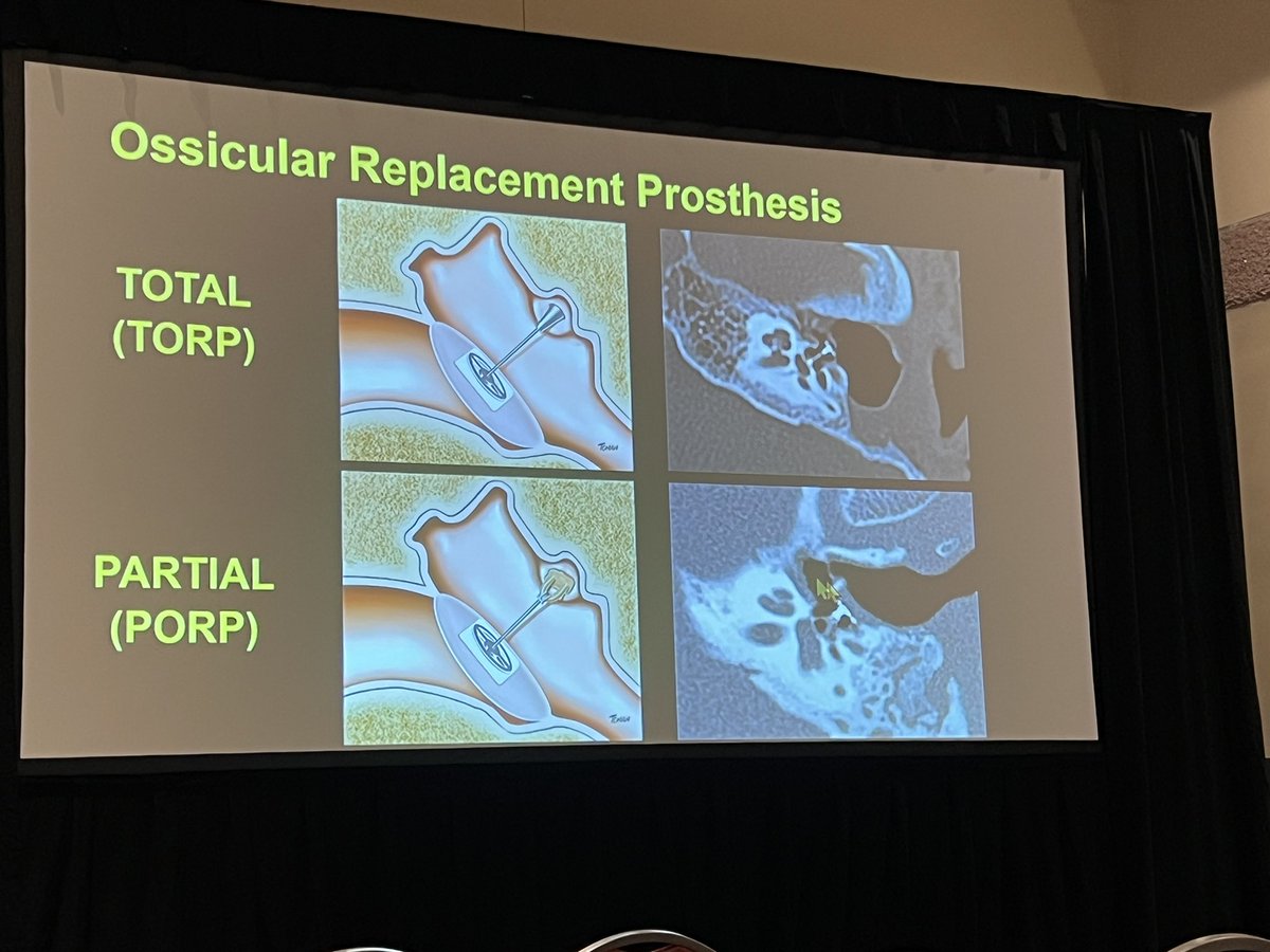 Postoperative temporal bone @HugoTames #ARRS24