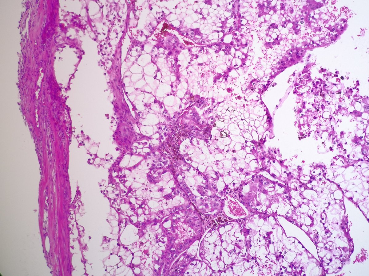 Playing the one high-power image game again: #1❓Organ #2❓Diagnosis Bonus 🌟 points for identifying the molecular profile! #PathTwitter #GUPath