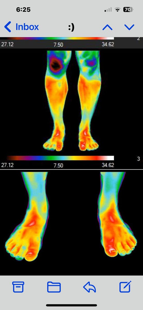 The sensitive of Hot Shots Thermography is amazing. I did not note any knee pain on my intake form (because pain is all relative, I did tear my MCL last year and of course no surgery was needed, our bodies heal on their own if we give them the right input). #TeamNeedham