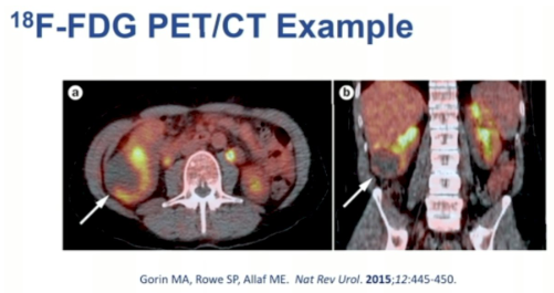 State-of-the-art lecture: Advances in molecular imaging for renal tumors. Presentation by @allaf_mo @HopkinsMedicine. #AUA24 written coverage by @RKSayyid @UofT > bit.ly/3wkGis7 @AmerUrological