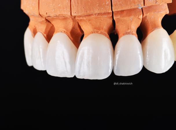 Zirconia crowns and bridges with Noritake CZR! Check out the before and after! 
#kuraray #noritake #czr #dental #dentist #dentallab