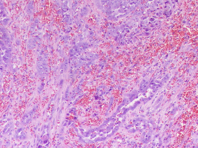 1/ 3 Dear #GUPath Fem on 50's.Renal neoplasm with many faces and suspects, at this moment just on morphologic basis, your favored dx or DDs and IHC request.
This is not a primary case and I just have report of what grossly was found 
Specimen sent on fragments as atrophic kidney…