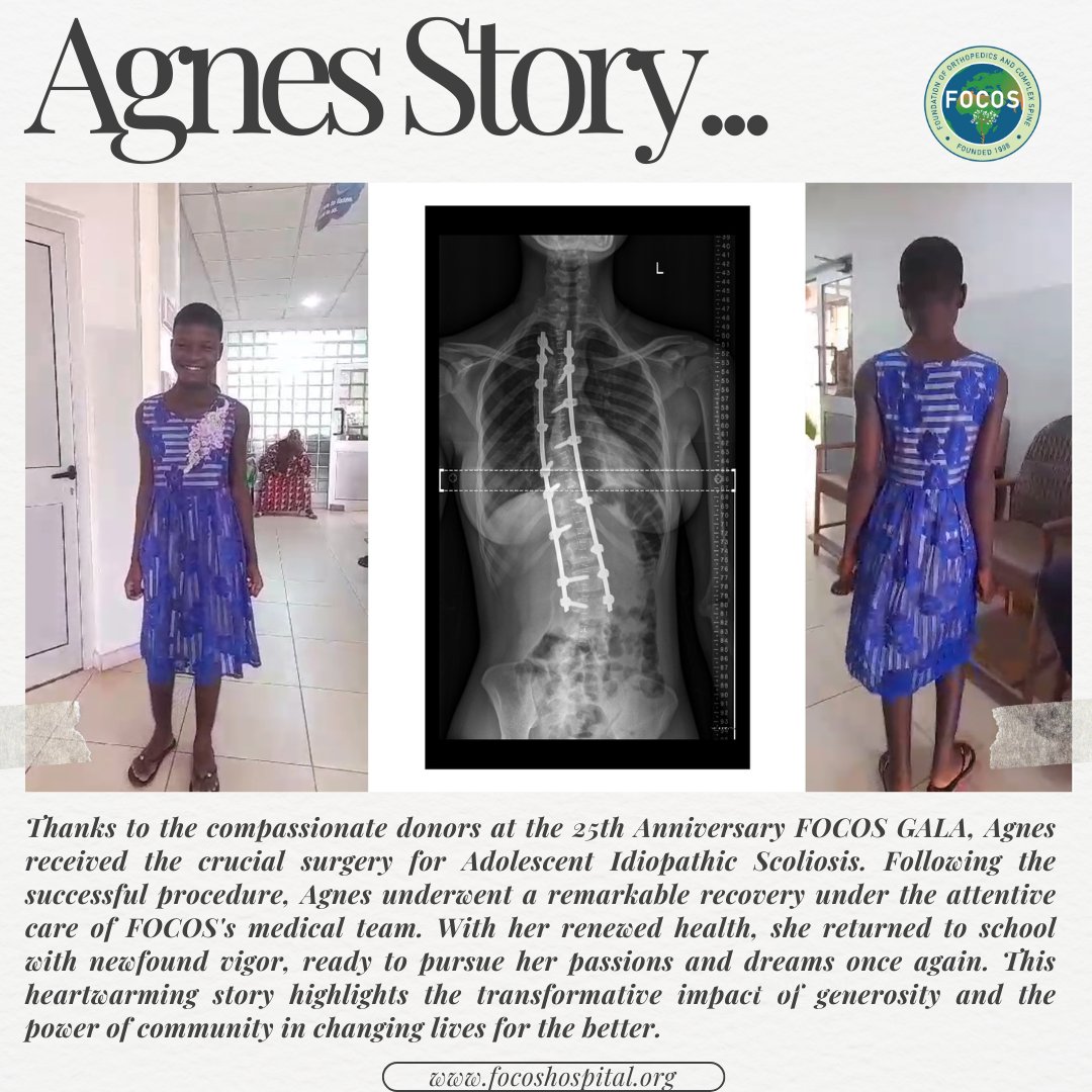 Meet Agnes, a 16-year-old whose life was forever changed by FOCOS and the generous donors of the FOCOS 25th Anniversary Gala. Dive into her inspiring journey and discover how your support can make miracles happen! #FOCOSSuccessStories#FOCOS25thAnniversary#HelpingTheWorldStandTall