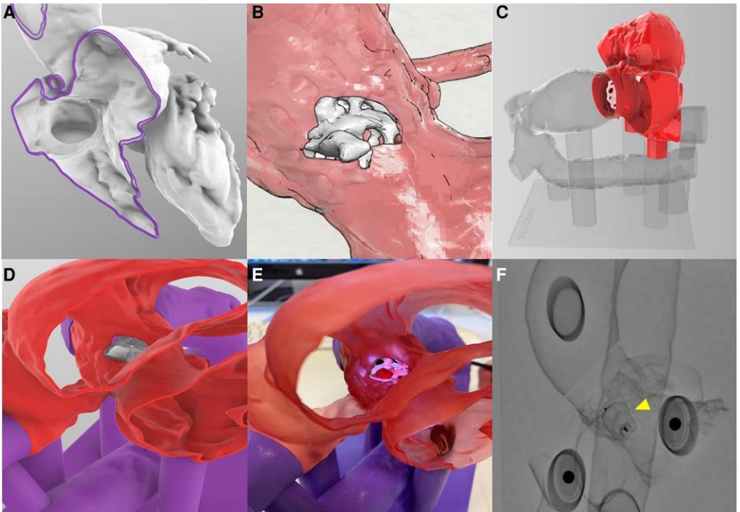 Julio Echarte (@jcecharte) on Twitter photo 🌟Just published our case on the innovative use of 3D printing 💡in percutaneous closure of aortic-to-right ventricle fistula post TAVR
<a href="/foroic/">ArmandoPérez dePrado</a> <a href="/AlfredoRedondoD/">Alfredo Redondo</a> <a href="/IreneTori/">Irene Toribio García</a> FelipeFernández
<a href="/shci_sec/">ACI-SEC: Hemodinamica</a> <a href="/ESC_Journals/">European Society of Cardiology Journals</a> <a href="/PCRonline/">PCRonline 🫀</a>
pubmed.ncbi.nlm.nih.gov/38707530/ 🌟Just published our case on the innovative use of 3D printing 💡in percutaneous closure of aortic-to-right ventricle fistula post TAVR
<a href="/foroic/">ArmandoPérez dePrado</a> <a href="/AlfredoRedondoD/">Alfredo Redondo</a> <a href="/IreneTori/">Irene Toribio García</a> FelipeFernández
<a href="/shci_sec/">ACI-SEC: Hemodinamica</a> <a href="/ESC_Journals/">European Society of Cardiology Journals</a> <a href="/PCRonline/">PCRonline 🫀</a>
pubmed.ncbi.nlm.nih.gov/38707530/