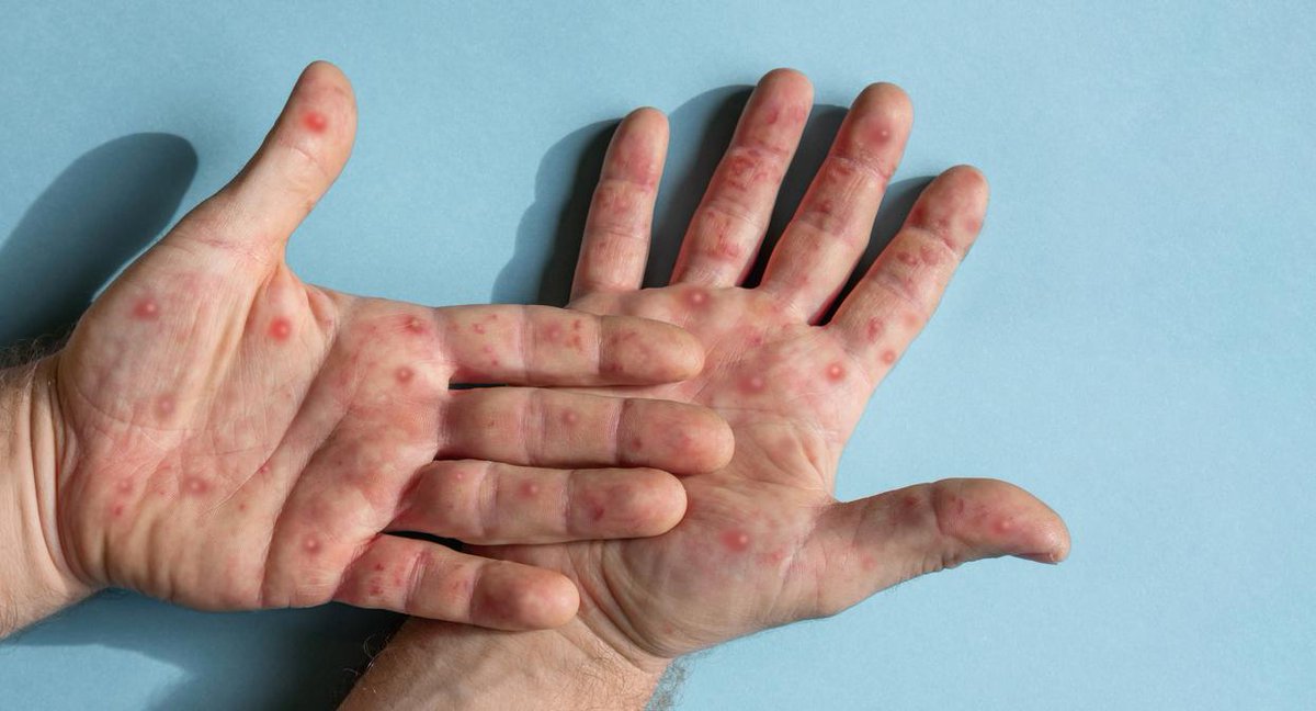 Substantial rise in mpox cases prompts NYC health alert Officials also urged health providers to watch for possible clade 1 cases in people with travel history or epidemiological connections to African outbreak locations. ow.ly/WZax50Rxzy6