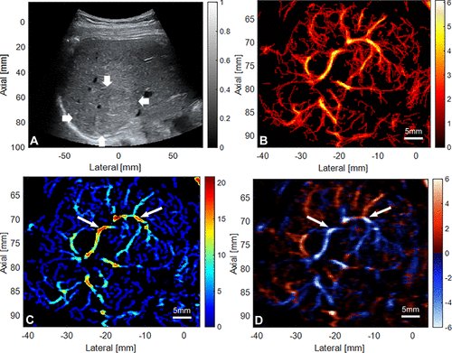 Super-Resolution US Imaging of Focal Nodular Hyperplasia pubs.rsna.org/doi/10.1148/ra…