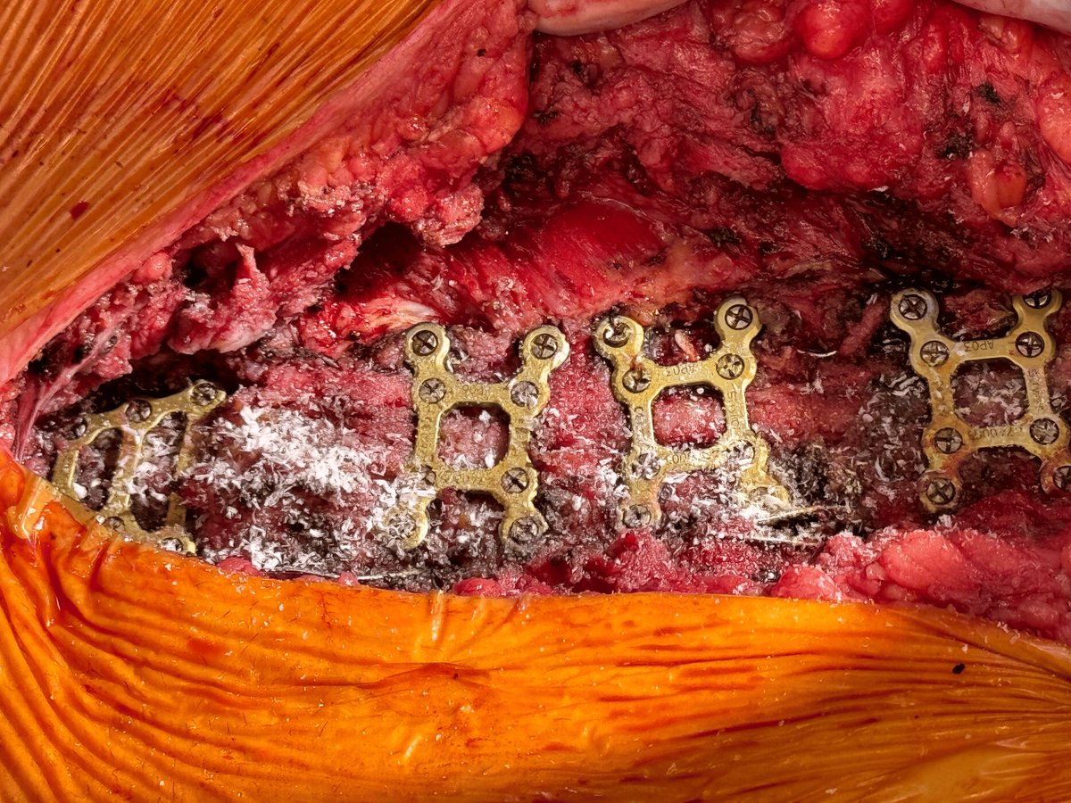 Multiple fractured sternal wires &amp; repeated sternal breakdown post-CABG &amp; Robicsek repair - consider a multifaceted approach of sternal plating, amniotic membrane &amp; PRP! 

📸 Photo 1 shows the preoperative chest X-ray revealing fractured first and sixth sternal wires.

📸 Photo 2