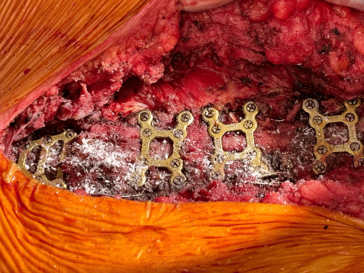 Multiple fractured sternal wires & repeated sternal breakdown post-CABG & Robicsek repair - consider a multifaceted approach of sternal plating, amniotic membrane & PRP! 

📸 Photo 1 shows the preoperative chest X-ray revealing fractured first and sixth sternal wires.

📸 Photo 2…