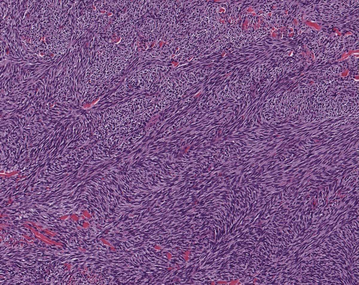 What is this spindle cell pattern? What tumors can it be seen in (and why is fibrosarcoma usually the WRONG answer)? Why does this pattern remind me of something from the 1990s? Answers: kikoxp.com/posts/14062. #BSTpath #pathologists #pathology #pathTwitter #dermpath