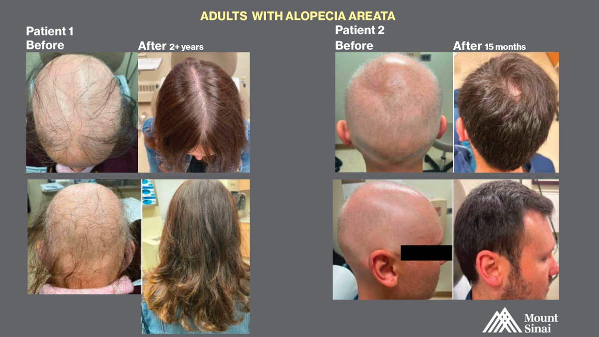 .@EmmaGuttman doesn’t give up on any patient. Severe cases have great outcomes through new treatments, making #happypatients #alopeciaareata #alopecia #beforeandafter #hairgrowth #hairtransformation @IcahnMountSinai