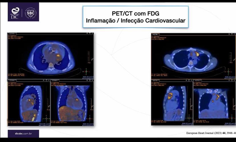 Nuclear Cardiology Hot Topics for @CongressodoDIC in Salvador ! #amyloidosis #INOCA #endocarditis @sbc_cientifico @DICSBC @alexsfelixecho @pabeda1 @carlosrochitte @onlineIJCS @AnaCatarinaOrt @MyASNC