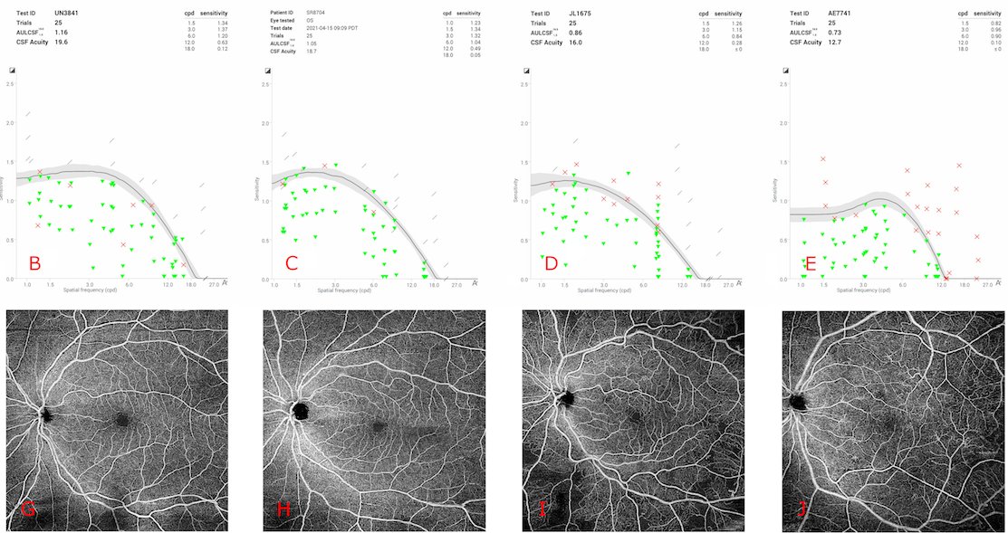 Sharing our new work from @HMSeye/@MassEyeAndEar on #qCSF contrast sensitivity across #DiabeticRetinopathy stages strongly correlating with progressive microvascular changes on #OCTA #retina #endpoints @mtm_vision @JohnBMillerMD @BMJ_Ophth #ophthalmology bjo.bmj.com/content/early/…