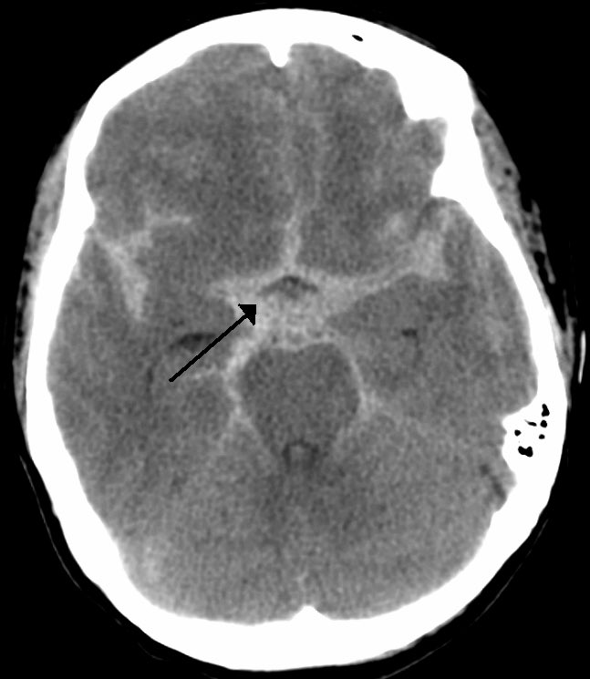 This 45 years old male comes to the office with hematuria and hypertension, What is the diagnosis and cause❓ Let’s see‼️‼️