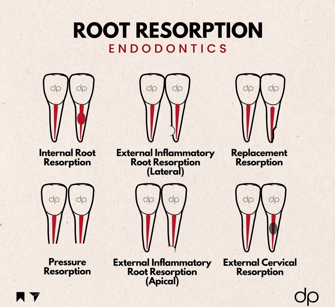Root resorption in endodontics
