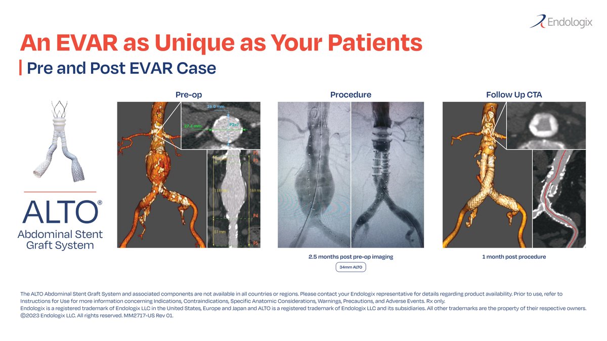 The ALTO Stent Graft is Anatomically Adaptive and Uniquely Powerful. Explore a Pre and Post #EVAR case example here: endologix.com/aaa/alto/ ISI: endologix.com/import-safety-…