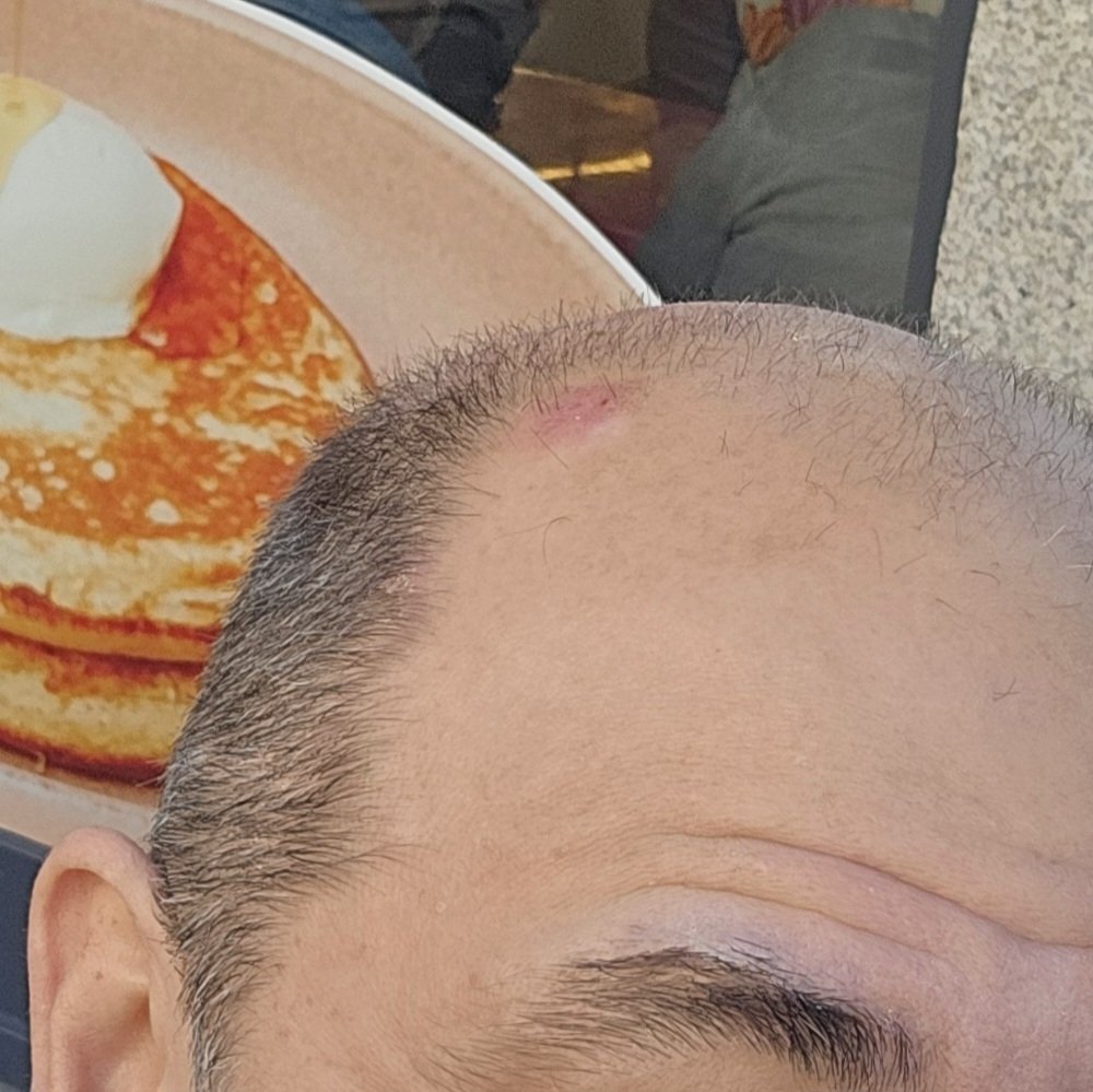 For today's #caminotuesday theme camino injuries, the morning I left our Porto hotel for the Camino, I bumped my head on the corner of the tv. 30-minute icepack delay & off we went. No other injuries.

#caminodesantiago #author #pilgrim