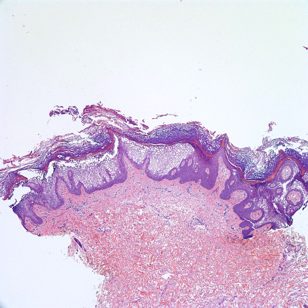 Hyperkeratotic flexural plaques since childhood. Pics & dx ✅ kikoxp.com/posts/17986 Videos⏯️ kikoxp.com/posts/4382 & kikoxp.com/posts/4242 More🔬kikoxp.com/posts/17983 & kikoxp.com/posts/17984 #pathology #pathologists #pathTwitter #dermpath #dermatology #dermtwitter