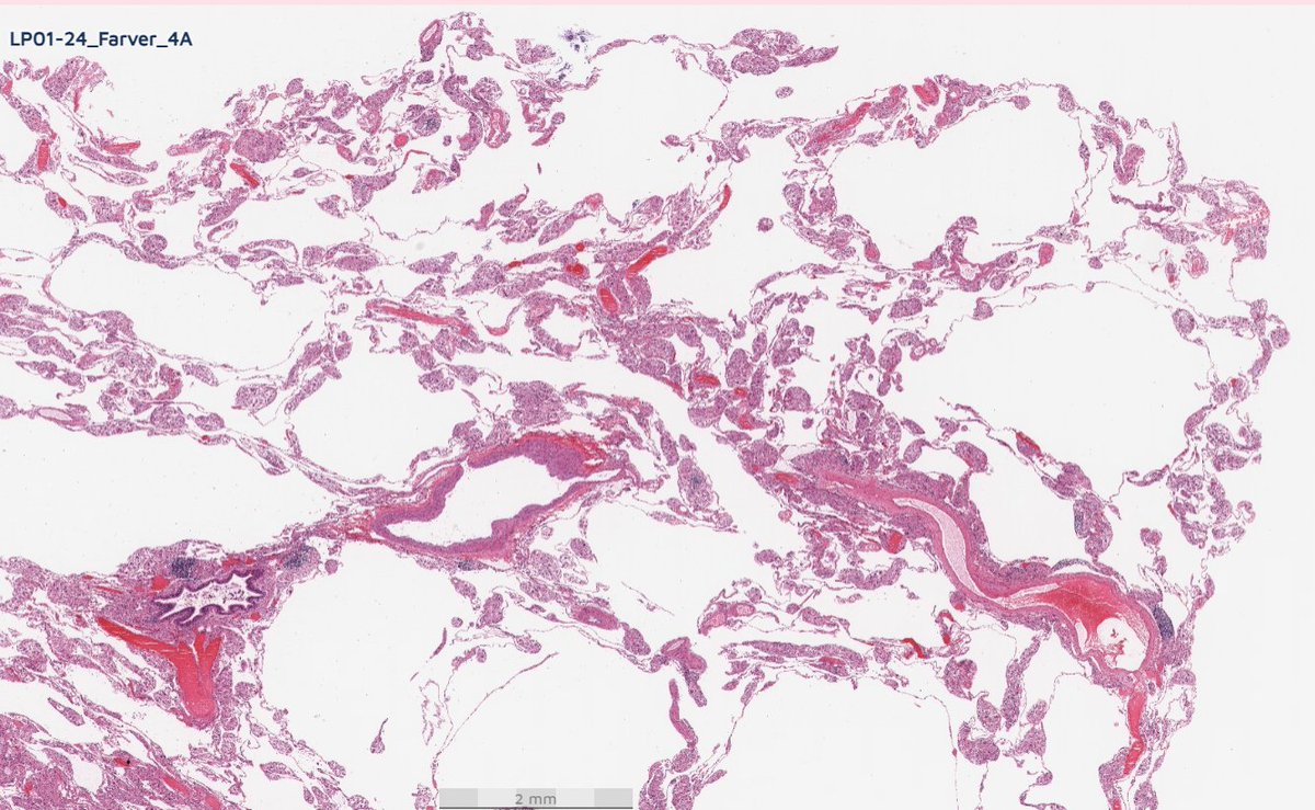 #EverydayLung
Emphysema and vascular granulomas?
Loosely formed granulomas located in the capillaries
Dr. Farver #USCAP2024 #LungPath #pathology #PathX #PathTwitter