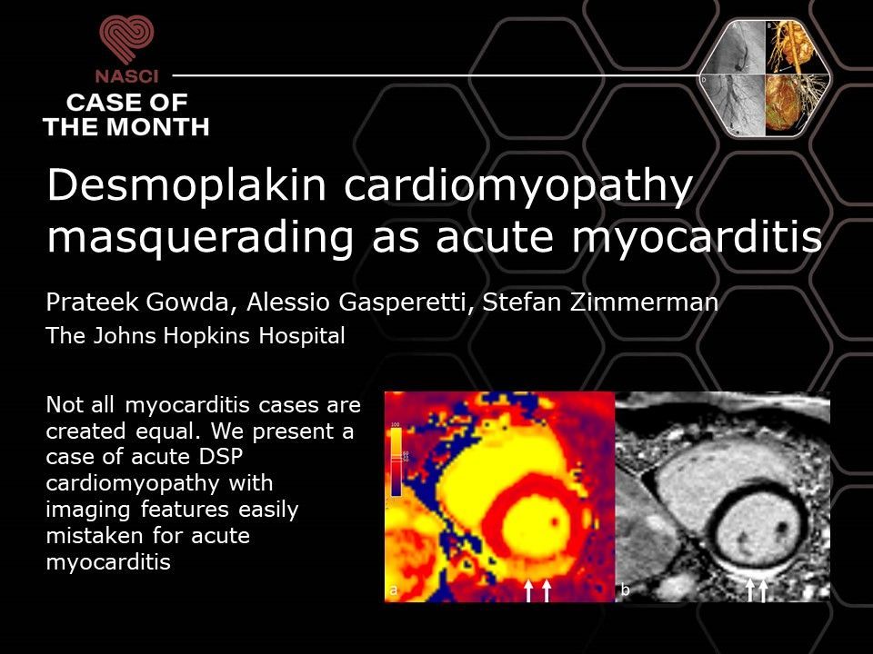 The #NASCI Case of the Month: Desmoplakin Cardiomyopathy Masquerading as Acute Myocarditis has been published in the @IJCVImaging! Read the full case report here: buff.ly/3UsR1bX #cardiovascularimaging @JRevRad1 @ShaimaaFadl1 @AwsHamid5 @LubaFrank11 @CardiacRad