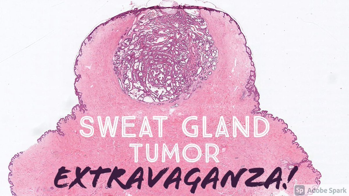 Sweat Gland Tumor EXTRAVAGANZA video: kikoxp.com/posts/6868. Rapid-fire discussion of 31 unknown slides in 1.25 hours. Enjoy! #pathology #pathologists #pathTwitter #dermpath #dermatology #dermatologia #dermtwitter