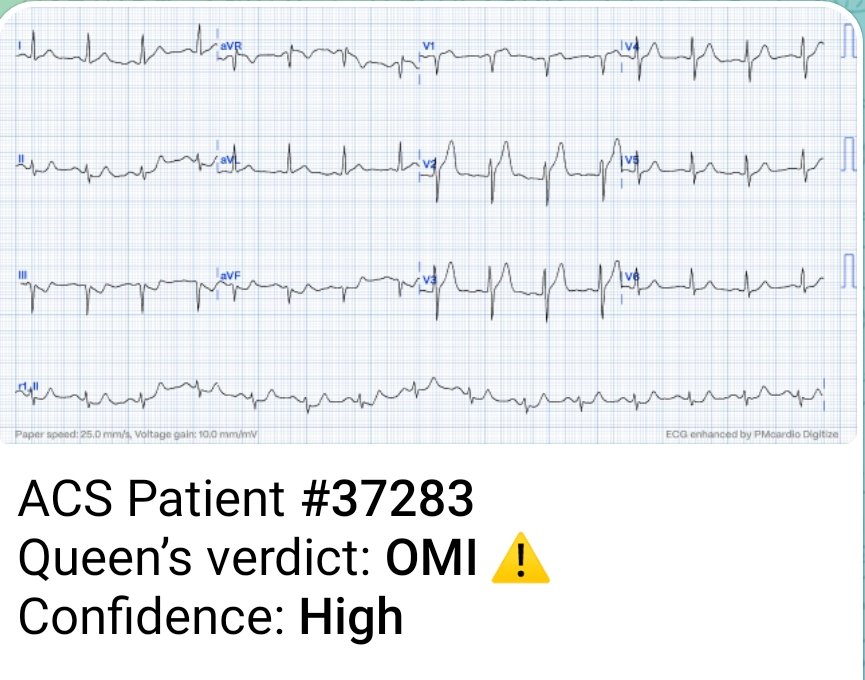 #ECG follow-up answer; Missed LAD OMI🤦13 hours later👇 @PMcardioApp @drharikrishrau #CardioTwitter #MedTwitter